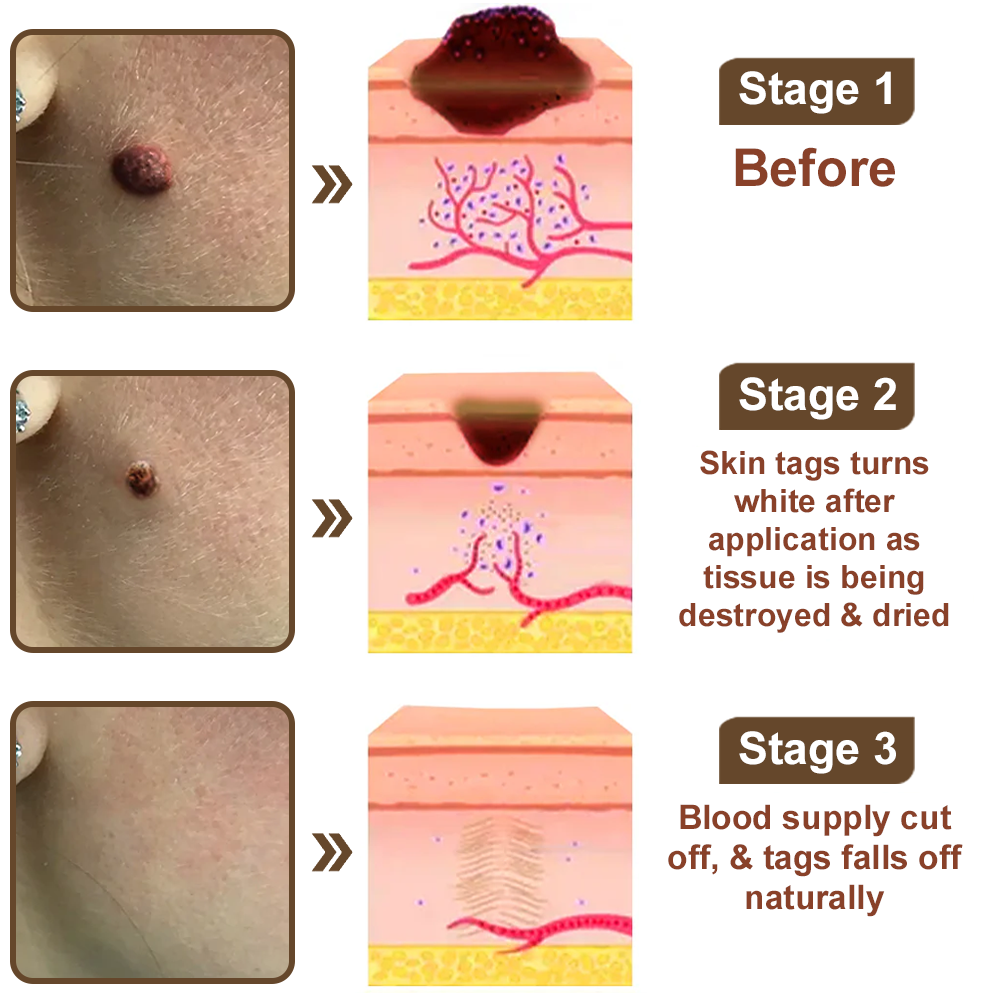 ODALIT™ Black Rice Skin Repair Essence Cream ⚕️ FDA Certified (Removes warts and skin growths, improves keratin buildup and seborrheic dermatitis, follicular keratosis, age spots, and bruising)