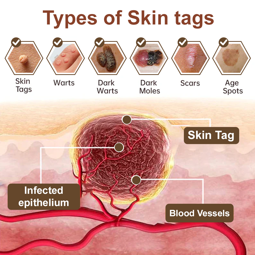 ODALIT™ Black Rice Skin Repair Essence Cream ⚕️ FDA Certified (Removes warts and skin growths, improves keratin buildup and seborrheic dermatitis, follicular keratosis, age spots, and bruising)