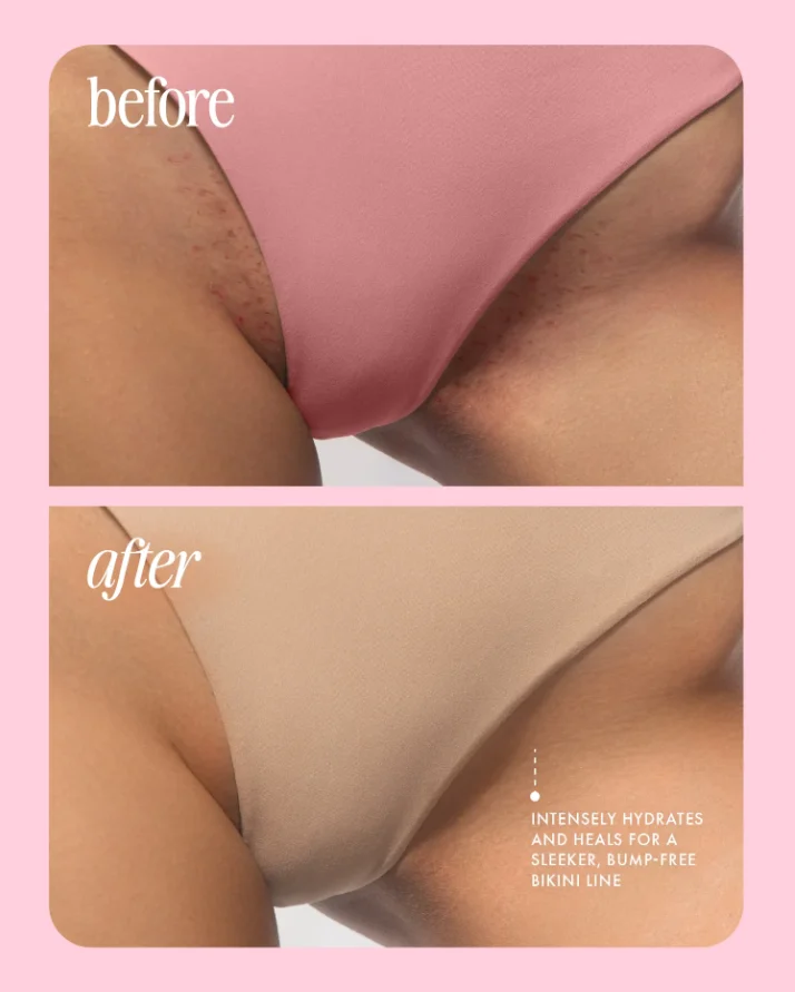 Goodbye Razor Bumps ✨ – Get Smooth, Glowing Skin in Just 5 Seconds with LBMLBM™ 🌟